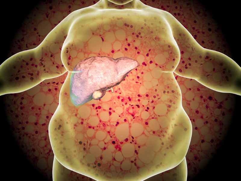 ไขมันพอกตับ ต้องลดไขมันหรือคาร์โบไฮเดรต?
